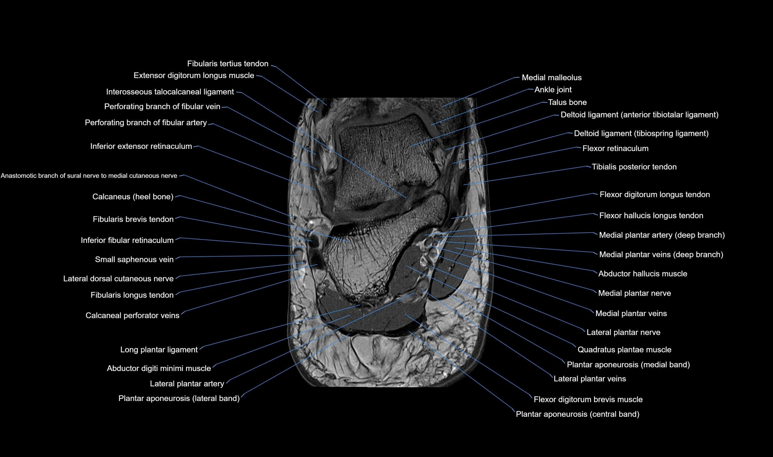 MRI mid foot axial cross sectional anatomy 3T  radiology  image-img-00001-00047.webp
